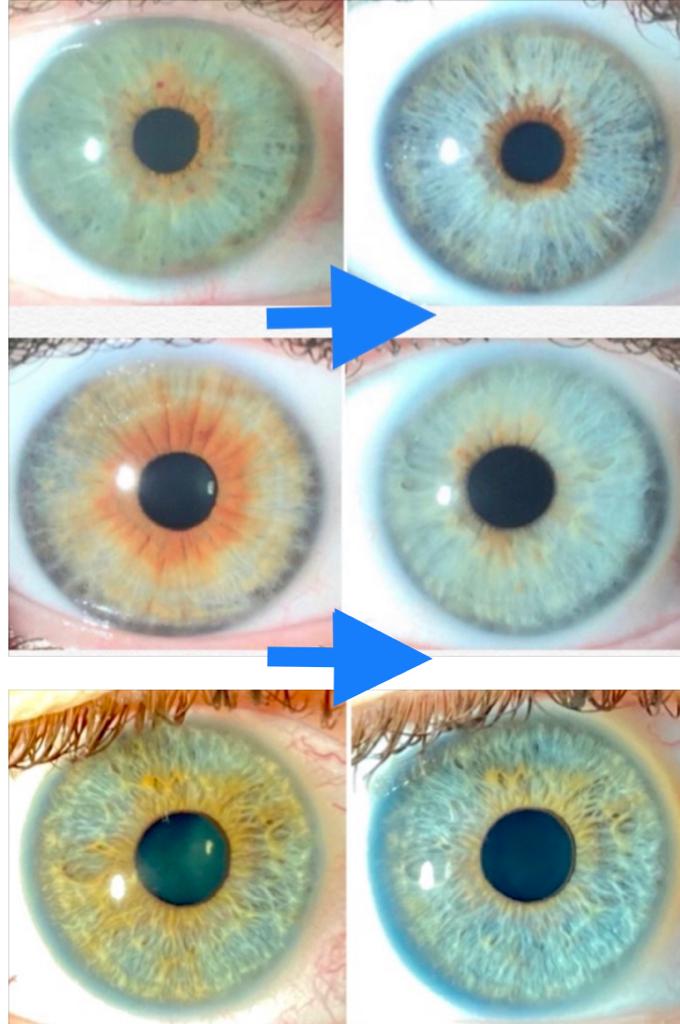 Images of before and after the treatment of eye color change
