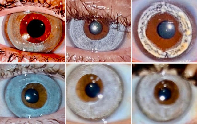Eye Color Change: Keratopigmentation versus laser depigmentation