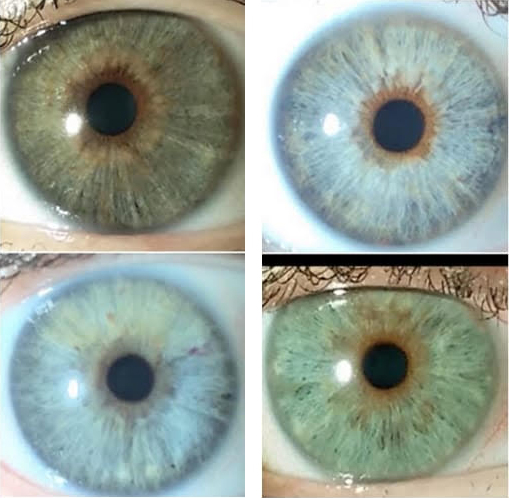 Eye Color Change: Keratopigmentation versus laser depigmentation